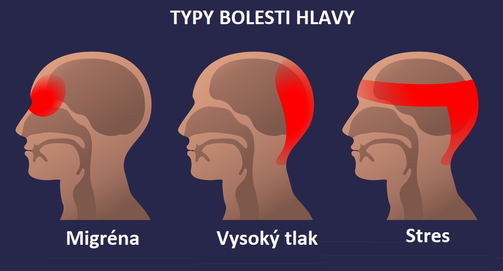 Jak se zbavit bolesti hlavy ze stresu?