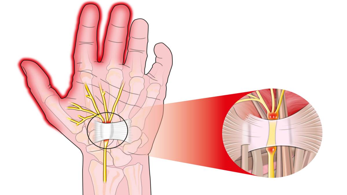 Příznaky syndromu karpálního tunelu | Zdravestravovani.eu