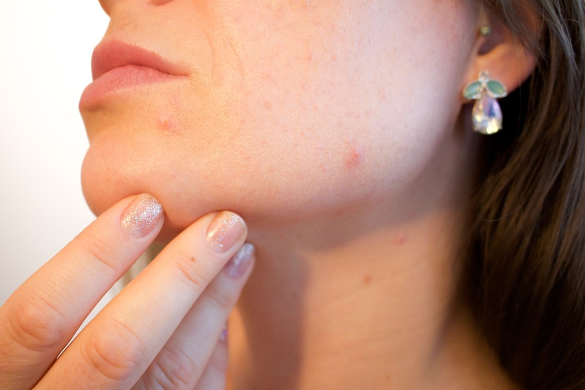 Detail tváře a čelisti mladé ženy trpící akné a ucpanými póry