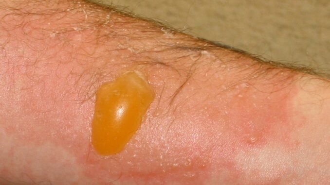 popalenina