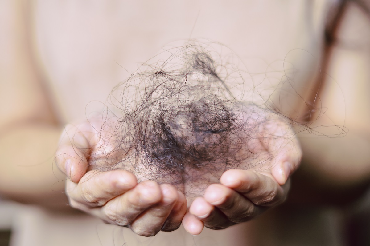 vlasy, alopecie
