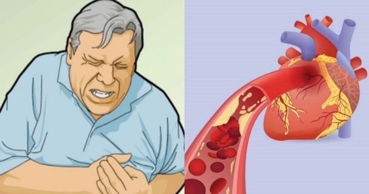 Veškeré příznaky srdečních onemocnění, jako je infarkt
