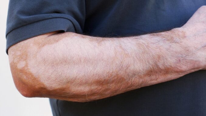 Vitiligo skvrny na kůži