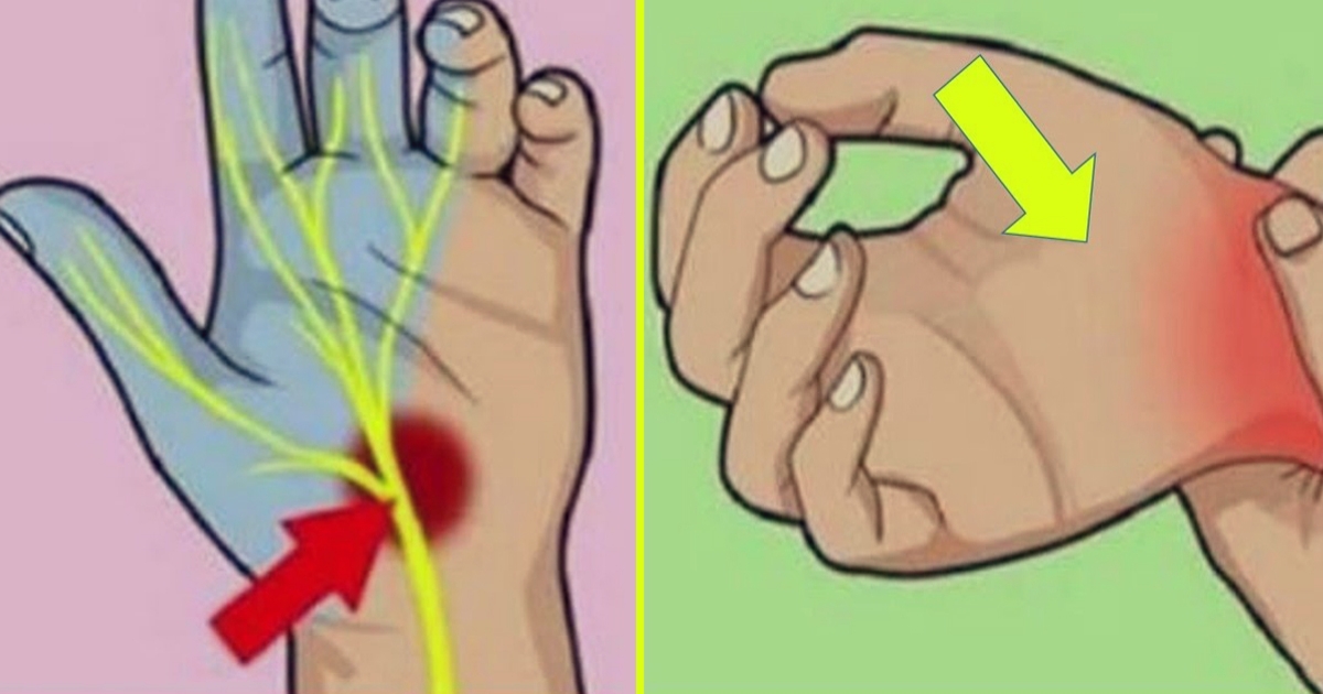 Немеет левый мизинец на левой руке. Покалывание в мизинце правой руки. Покалывания в правой руке как иголками. Покалывание в кончиках пальцев рук. Контрактура дюпюитрена.